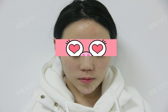 【武汉康美莱-鼻综合第零天】总觉得自己鼻子