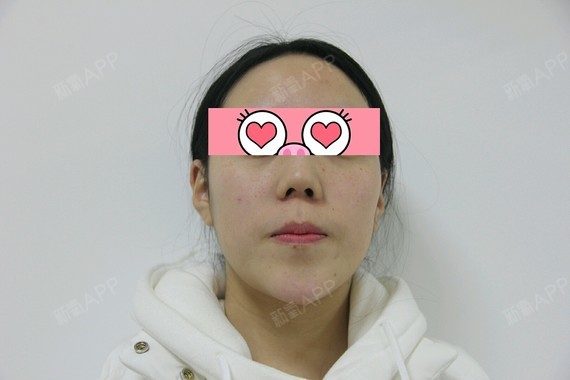 【武汉康美莱-鼻综合第零天】总觉得自己鼻子