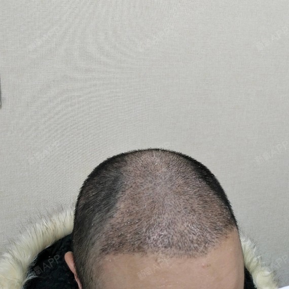 #种植头顶头发术后半个月#术后半个月过来复