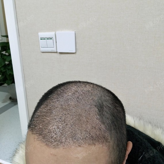 #种植头顶头发术后半个月#术后半个月过来复