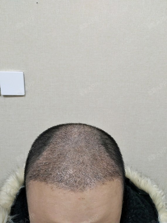 #种植头顶头发术后半个月#术后半个月过来复