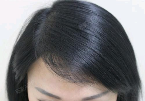 当今时代,发际线高是一种常见的头发问题,它严