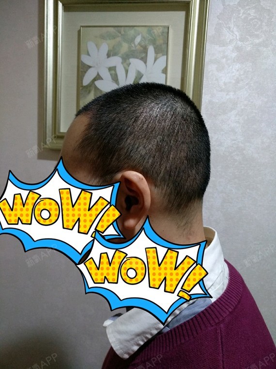 氧气6670581507618653种植发际线第14天美