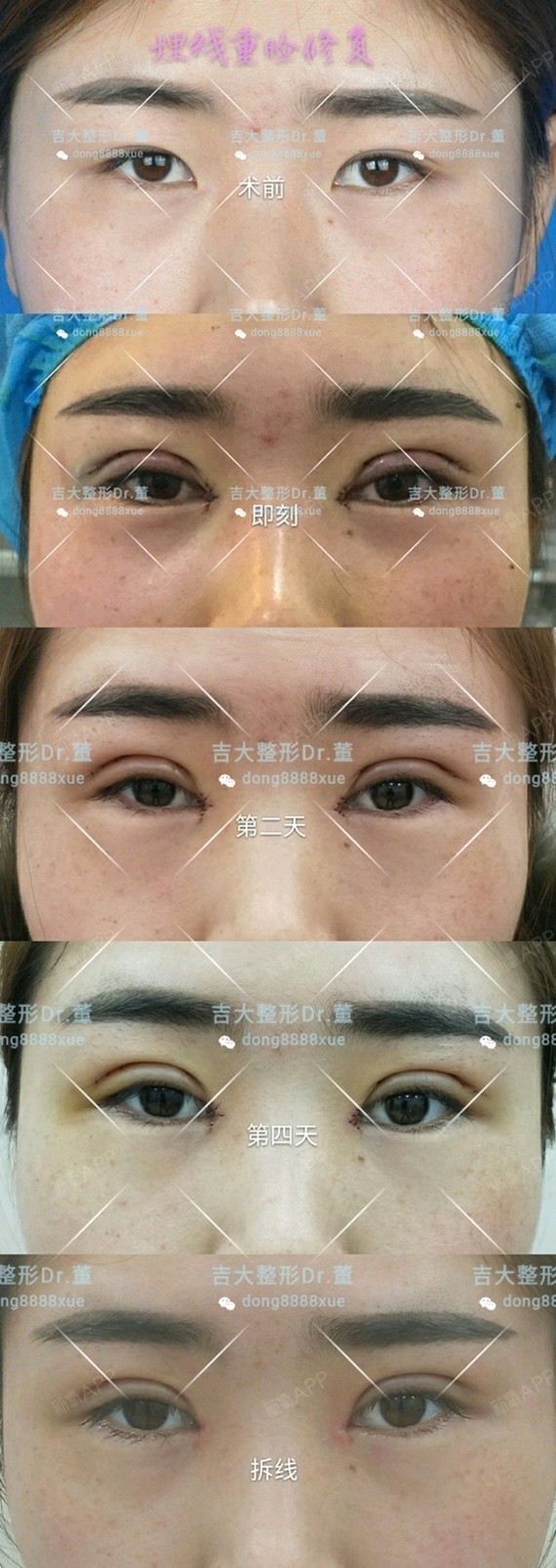 埋线重睑两年后自觉形态欠佳,过窄,行切开重睑 内眦开大