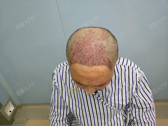 #种植头顶头发术前设计中#一直找不到合适的