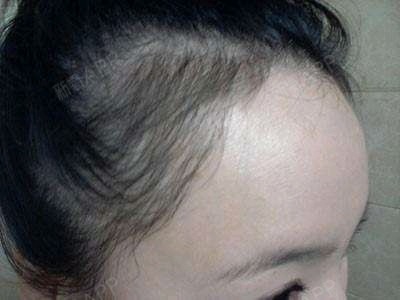头发种植后是否还会脱发?头发种植是利用自身