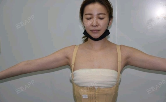 【北京天使名源自体脂肪隆胸第0天】这是我第一次写隆胸的日志,还要po
