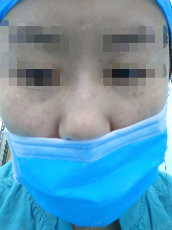 之前有人推荐我做皮秒,不知道做皮秒效果怎么