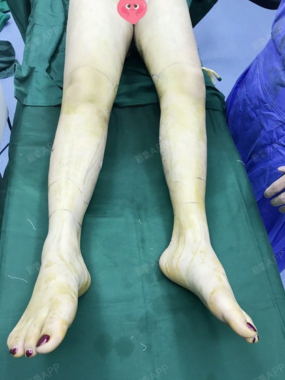 性感小野猫喔吸脂瘦小腿第0天美丽日记