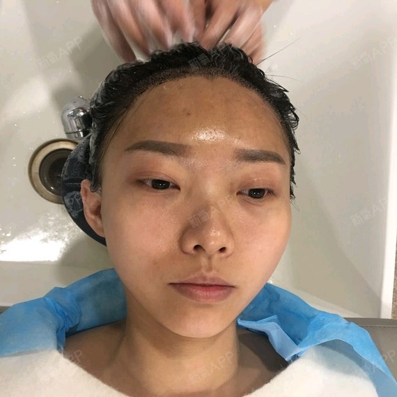 #种植发际线手术后三天洗头#大脑门已经不复