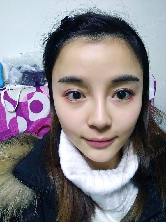 成都开外眼角好不好_效果图_氧气xee8a12开外眼角术后第14天_新氧美容