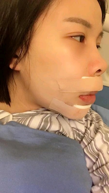 上下颚手术/突嘴矫正第3天