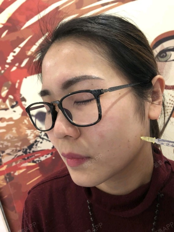 瘦脸针打咬肌