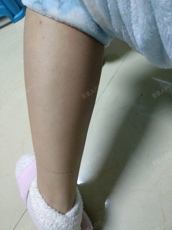评论       2条 腿部肌肉硬邦邦的是不是打肉毒素效果好一点