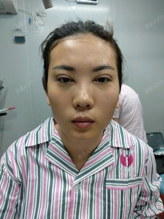 氧气6420631517554822定点双眼皮第9天美丽