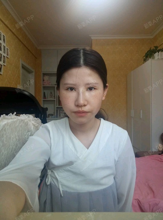 20天前做的线雕鼻,现在淤青一直没褪。现在左