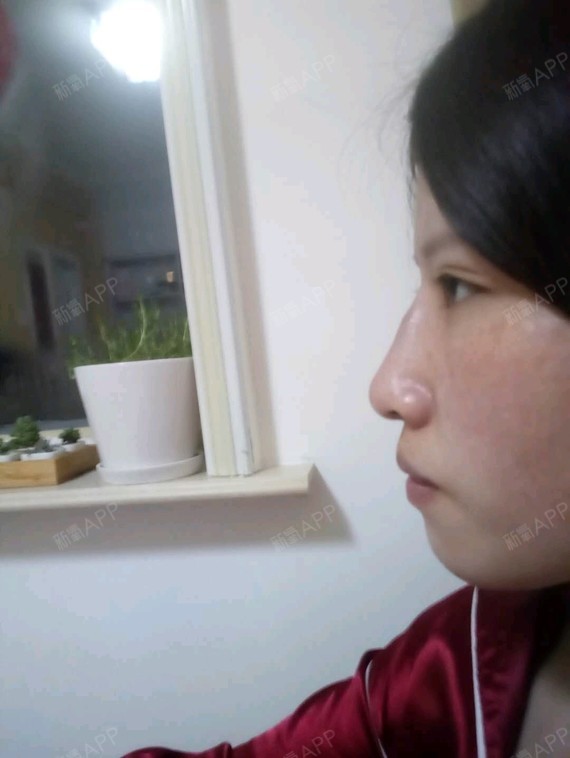 20天前做的线雕鼻,现在淤青一直没褪。现在左