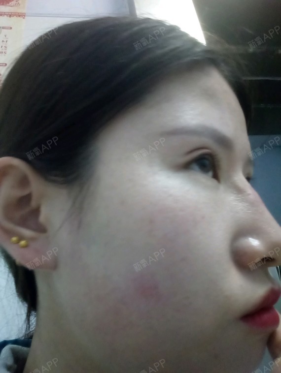 20天前做的线雕鼻,现在淤青一直没褪。现在左