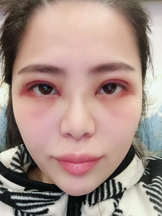 今天一天一直在冰敷翻眼皮冰敷翻眼皮,一方面是为了消肿一方面是为了