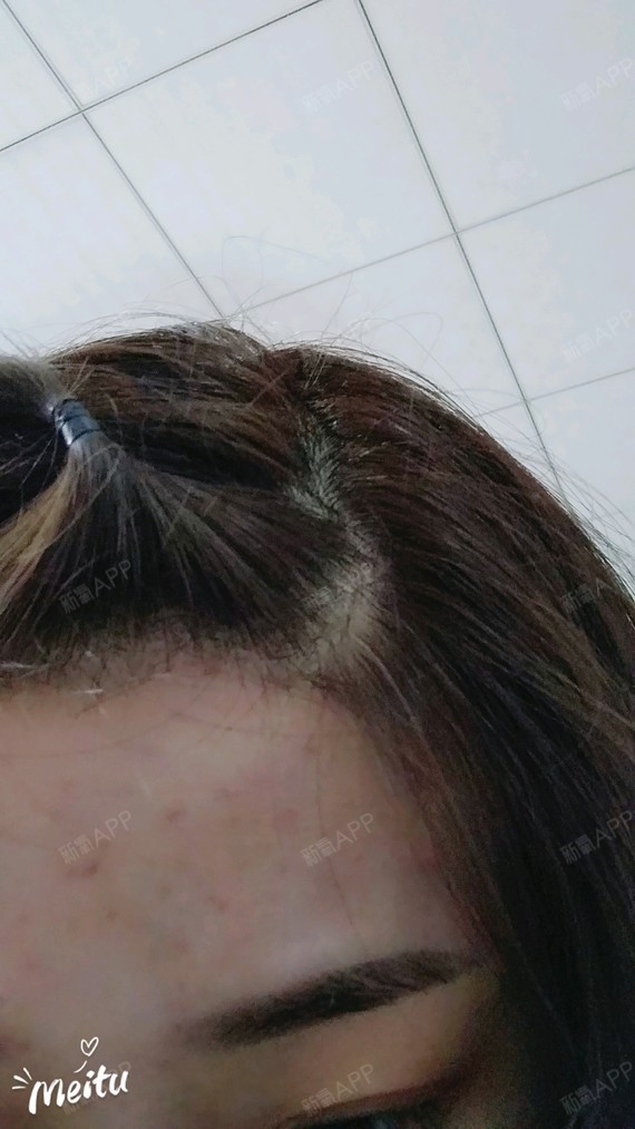 激光脱毛