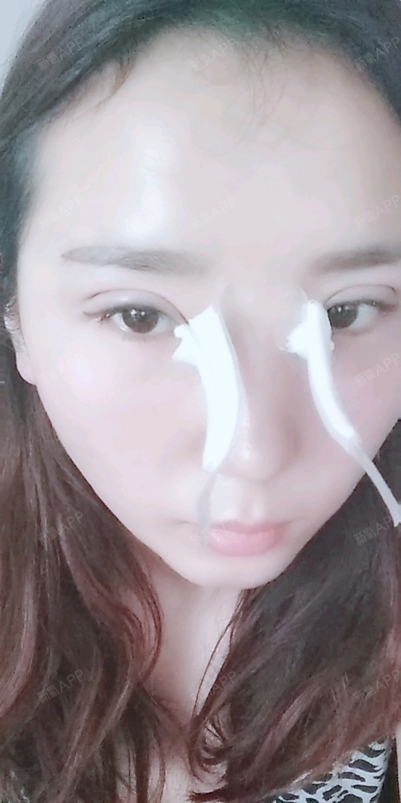 切开双眼皮