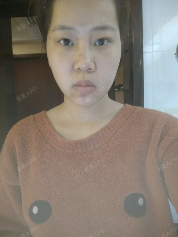 脸部大小脸怎么改善,去过颊脂垫,右边有一点硬