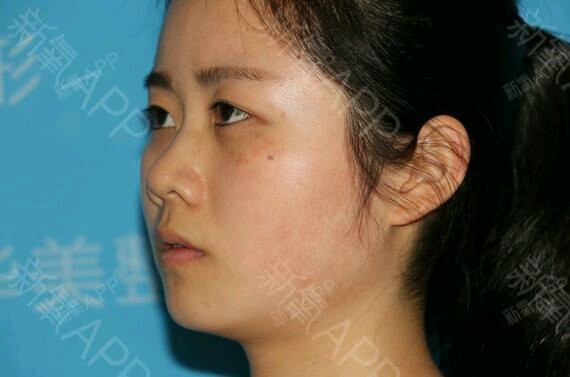 【合肥华美】激光去除红血丝后应该怎么护理?