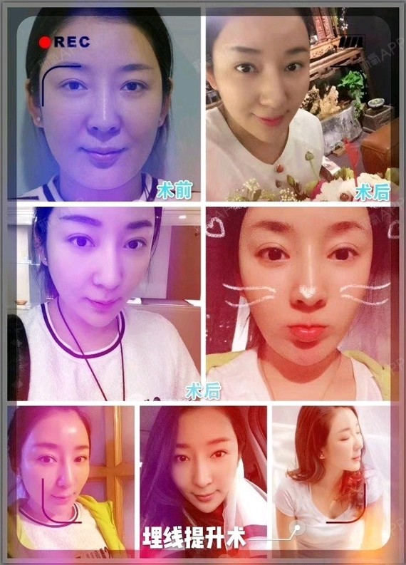 [色]线雕原理:一种可被人体吸收的美容线,在吸收过程中,6-8个月期间