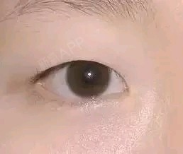 很多要做眼部整形的小仙女都会遇到这样的情况