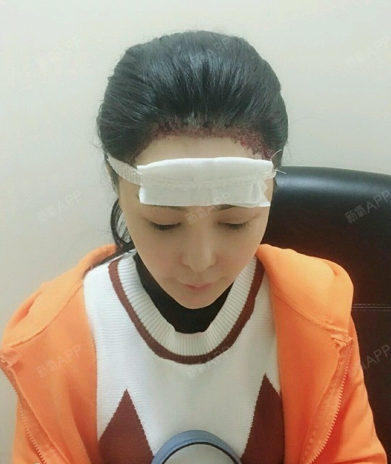 氧气三号种植发际线第0天美丽日记-新氧美容整