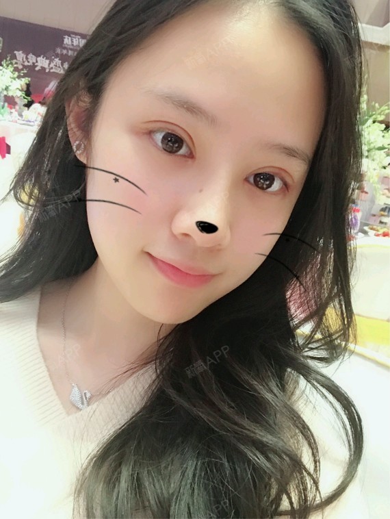 (武汉华美)割双眼皮多少毫米才适合自己,这个疑问是很多想要做双眼皮