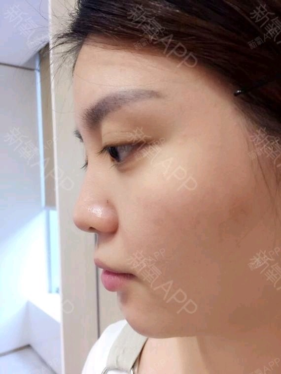 蘑菇小男孩玻尿酸垫下巴第0天美丽日记-新氧美