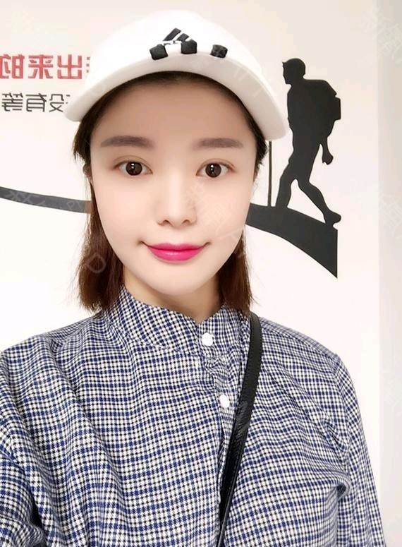 蘑菇小男孩玻尿酸垫下巴第1天美丽日记-新氧美