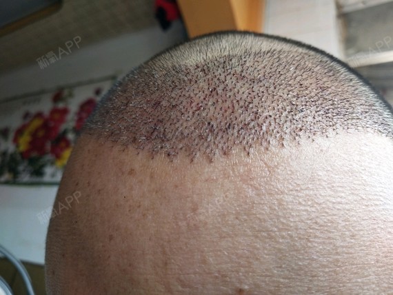 昆明雍禾植发进廷种植发际线第20天美丽日记