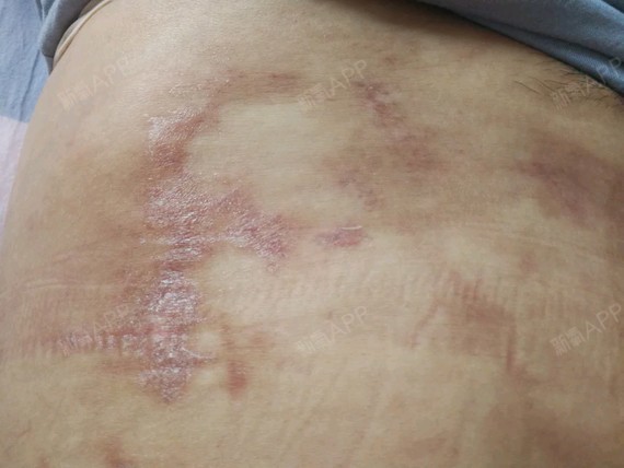 吸脂手术失败,这就是我在天津河东美莱医院做的腰腹环