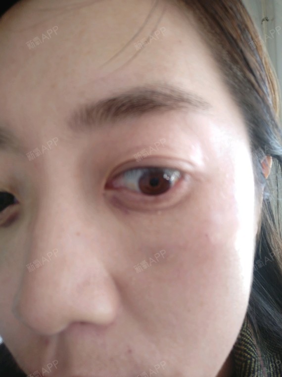 激光去眼袋
