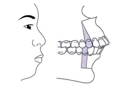 关于嘴突的问题我们先要从正面侧面等多个角度