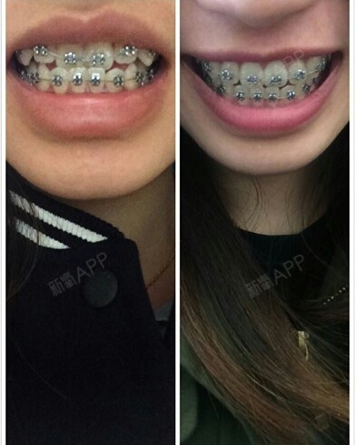 牙套托槽自锁_普通牙套托槽种类图片_牙套自锁托槽