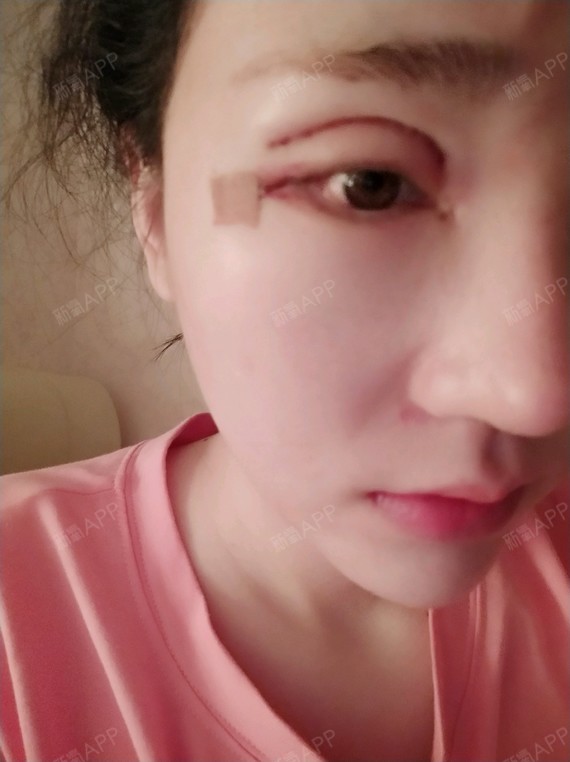 新氧 爱美的楠楠 眼部 开眼角 开内眼角 开外眼角 术后当