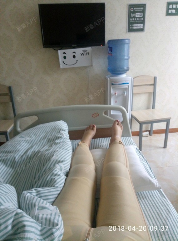 吸脂瘦小腿