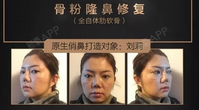 名医专技】鼻部整形大咖王旭明:给需骨粉隆鼻修复患者带来福音!