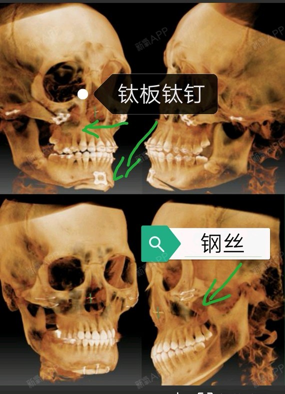 补充上一篇颅颌面外科固定材料.