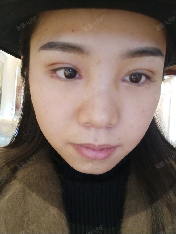 氧气9474491516712332开内眼角第23天美丽