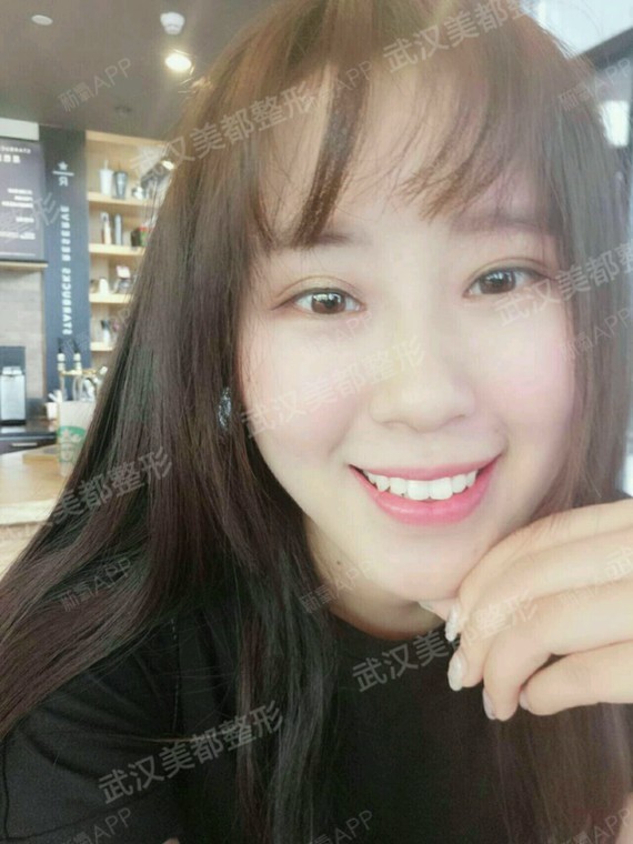 发际线调整小美女发际线调整第五天,能看出来