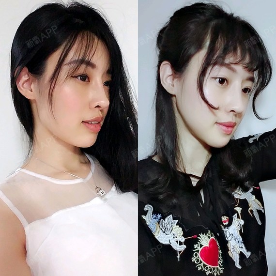 颧骨降低 | 上颚整形 | 下颚整形 | 硅胶垫下巴 | v-line瓜子脸手术
