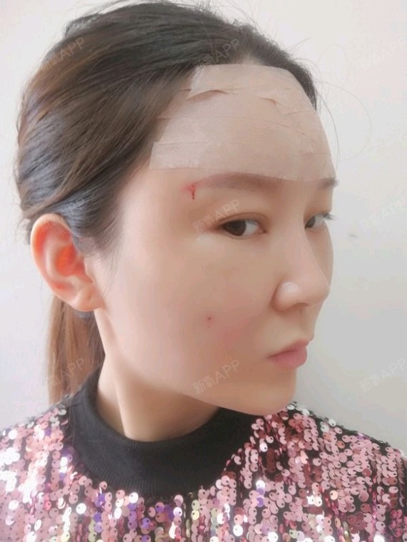 自体脂肪面部填充