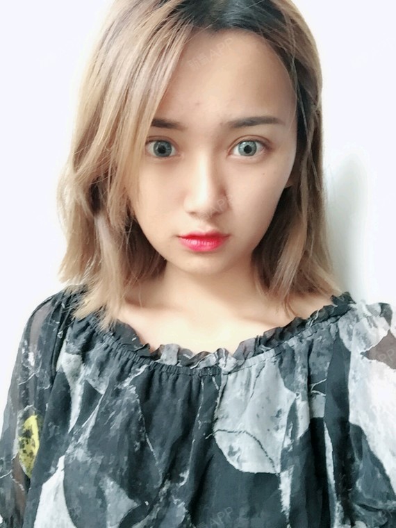 苏梦芸切开双眼皮第277天美丽日记-新氧美容整