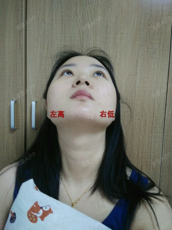上窄下宽,颧骨更宽一点导致左右脸显得明显不对称,下颌角也是外翻并