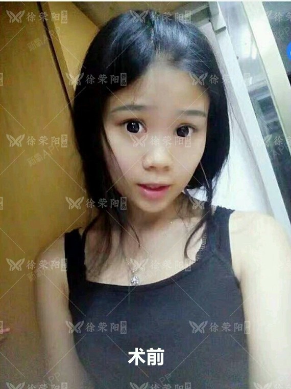 小小一块假体,让她变回美女。通过假体垫下巴