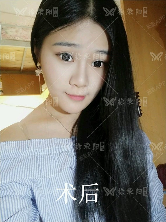 小小一块假体,让她变回美女。通过假体垫下巴